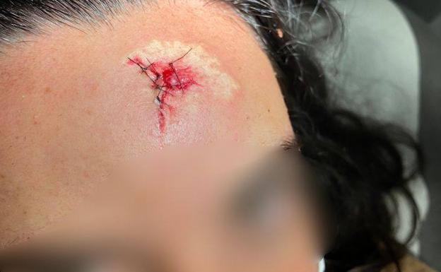 Un detalle del daño causado por la piedra que golpeó su frente. 