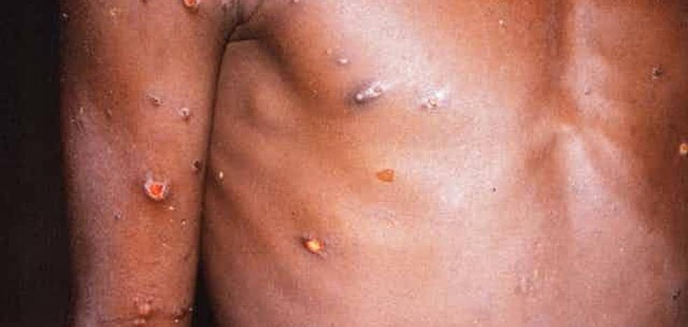 The monkeypox virus is an old acquaintance
