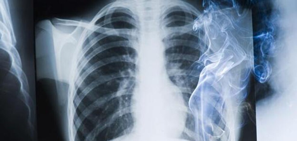 Spanish researchers raise hope for lung cancer